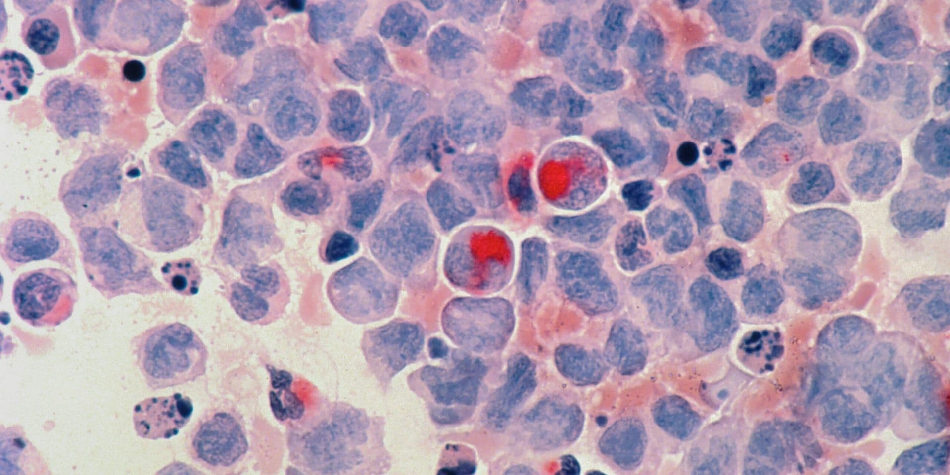 FDA Approves First Gene-Editing Therapy for Sickle Cell Disease