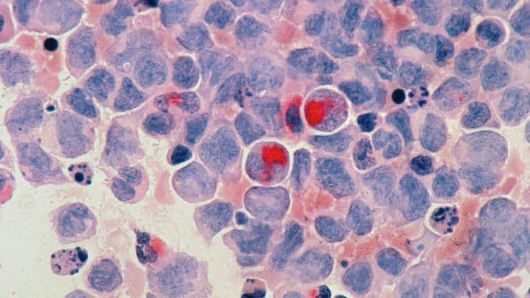 FDA Approves First Gene-Editing Therapy for Sickle Cell Disease